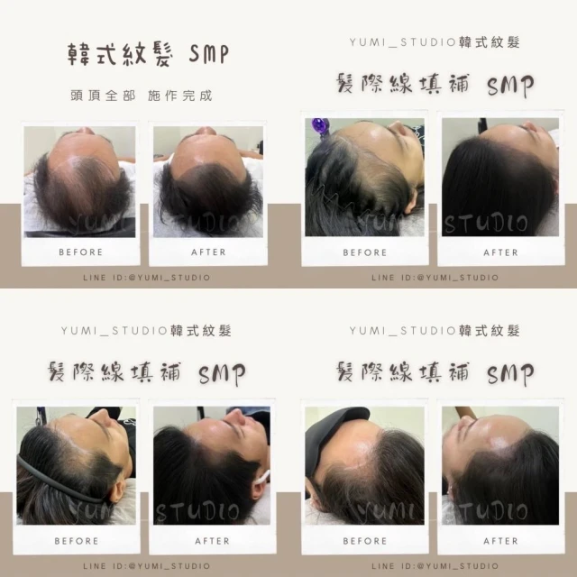 韓式頭皮紋繡SMP－髮劑線填補