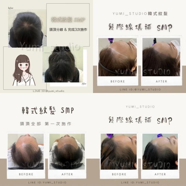 韓式頭皮紋繡SMP－頭頂全部