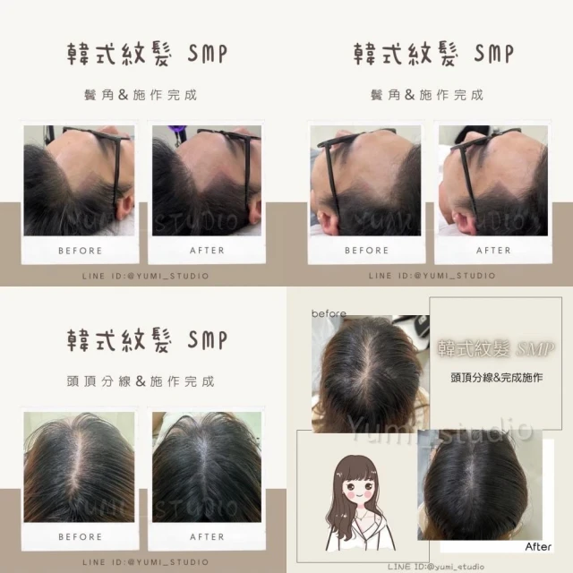 韓式頭皮紋繡SMP－髮際線填補