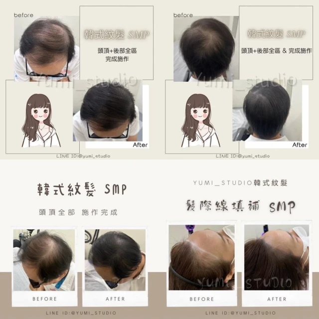 韓式頭皮紋繡SMP－頭頂分線